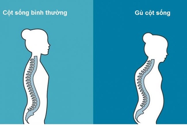 Hình ảnh minh họa bệnh gù lưng
