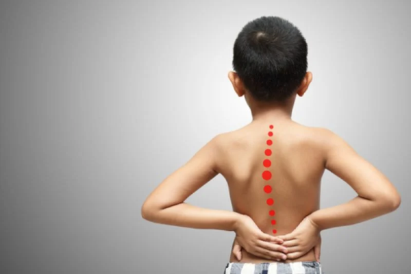 Nguyên nhân và giải pháp phòng ngừa bệnh gù lưng ở trẻ em